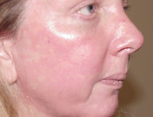 Laser Resurfacing 05 Patient After