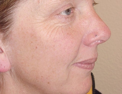 Laser Resurfacing 05 Patient Before