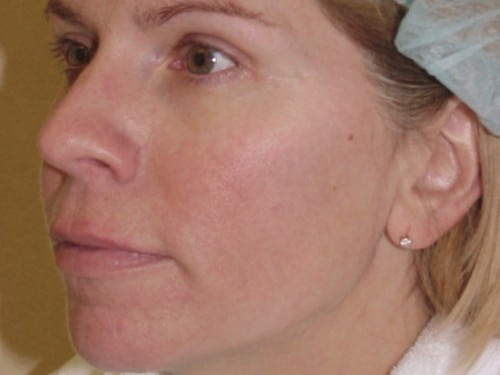 Laser Resurfacing 07 Patient Before