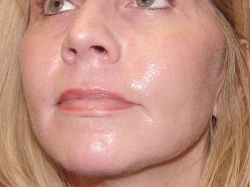 Laser Resurfacing 07 Patient After