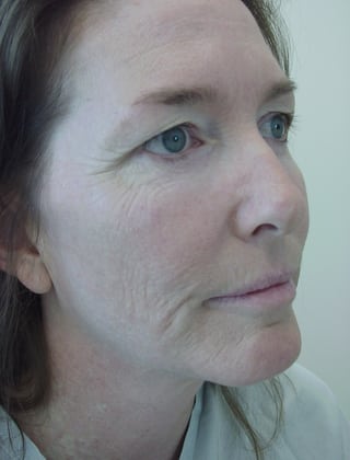 Laser Resurfacing 09 Patient Before