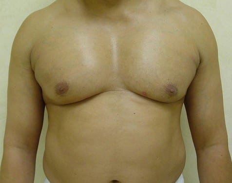 Male Chest Implant 01 Patient After