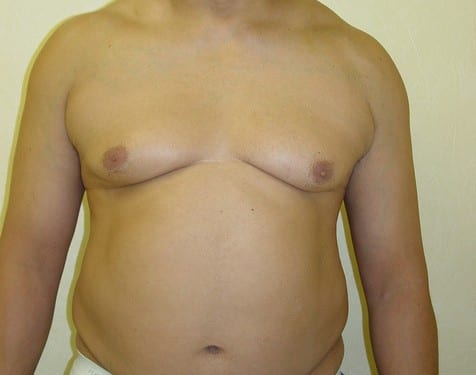 Male Chest Implant 01 Patient Before