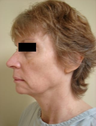 Neck Lift 01 Patient Before