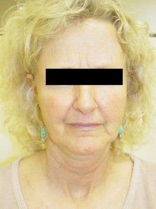 Neck Lift 10 Patient Before