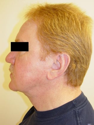 Neck Lift 12 Patient After