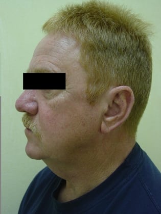 Neck Lift 12 Patient Before