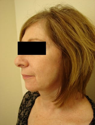 Neck Lift 02 Patient After