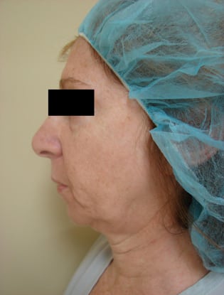 Neck Lift 02 Patient Before