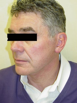 Neck Lift 05 Patient After