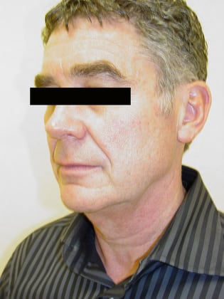 Neck Lift 05 Patient Before