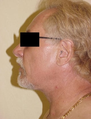 Neck Lift 06 Patient After