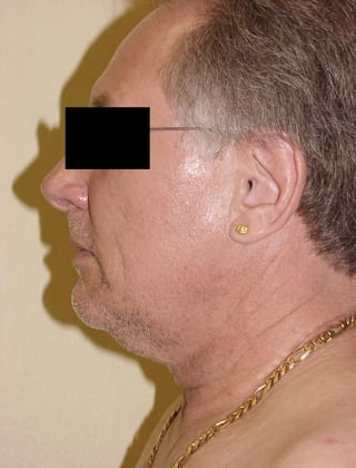 Neck Lift 06 Patient Before