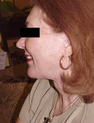 Neck Lift 08 Patient After