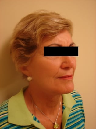 Neck Lift 09 Patient After