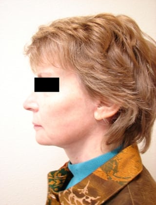 Neck Lift 01 Patient After
