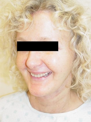Neck Lift 10 Patient After