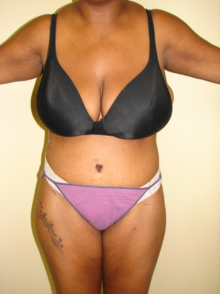 Abdominoplasty 11 Patient After