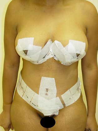 Abdominoplasty 07 Patient After