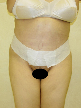 Abdominoplasty 08 Patient After