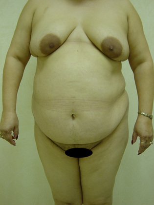 Abdominoplasty 08 Patient Before