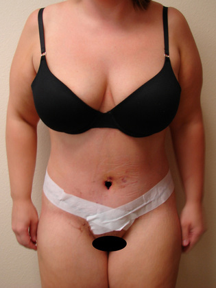 Abdominoplasty 06 Patient After