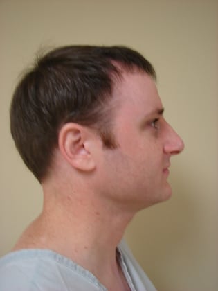 Rhinoplasty 10 Patient Before