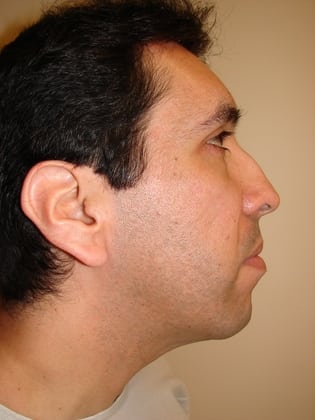 Rhinoplasty 11 Patient Before