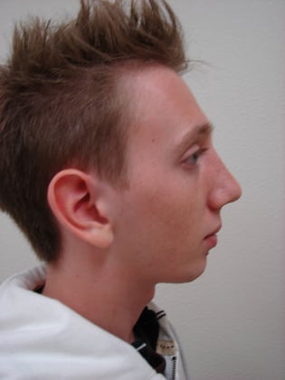 Rhinoplasty 02 Patient After