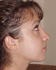 Rhinoplasty 03 Patient After