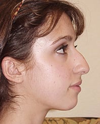 Rhinoplasty 03 Patient Before