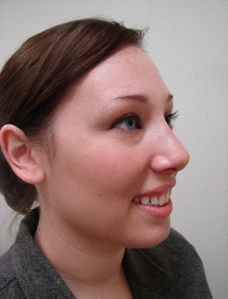 Rhinoplasty 05 Patient After