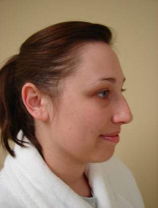 Rhinoplasty 05 Patient Before