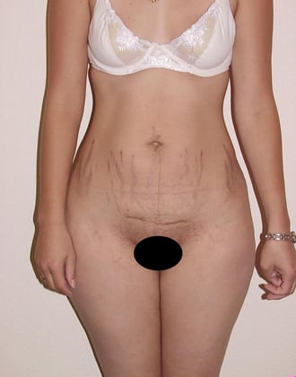 Tummy Tuck 01 Patient Before