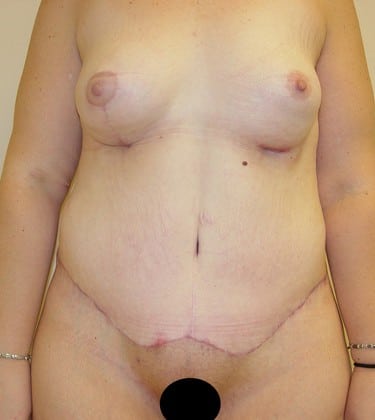 Tummy Tuck 10 Patient After