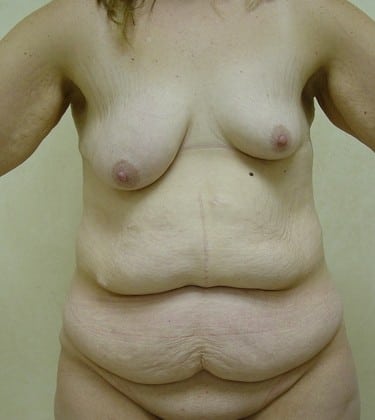 Tummy Tuck 10 Patient Before