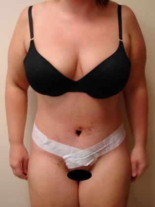 Tummy Tuck 12 Patient After