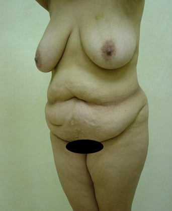 Tummy Tuck 03 Patient Before