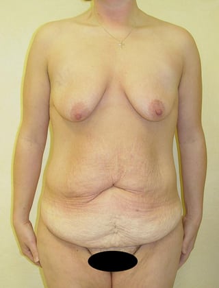 Tummy Tuck 04 Patient Before
