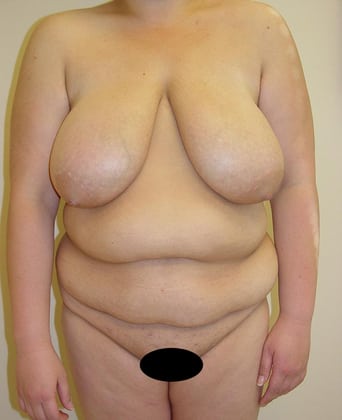 Tummy Tuck 05 Patient Before
