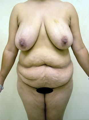 Tummy Tuck 07 Patient Before