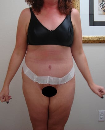 Tummy Tuck 08 Patient After