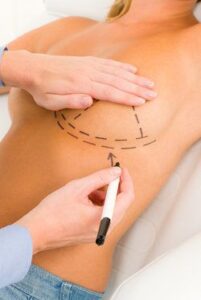 Woman with surgeon drawing lines on breasts