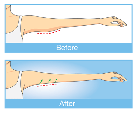 Armlift procedure diagram