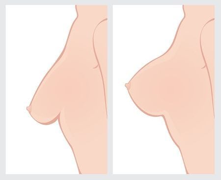 breast Lift procedure diagram