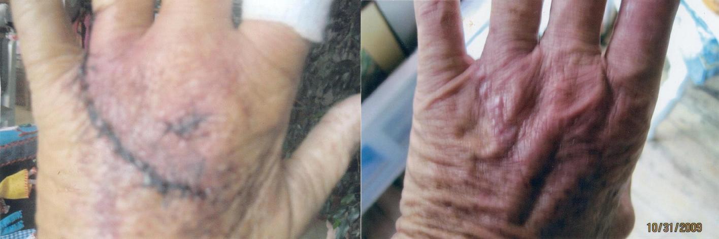 image of patient hand before and after