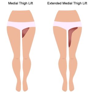 thigh-lift-areas-infographic
