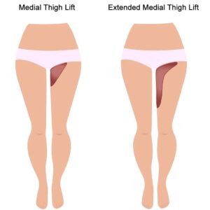 Thigh Lift Surgery: Comparing the Surgical Techniques - Feature Post Image