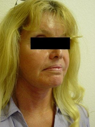 Neck Lift 14 Patient After