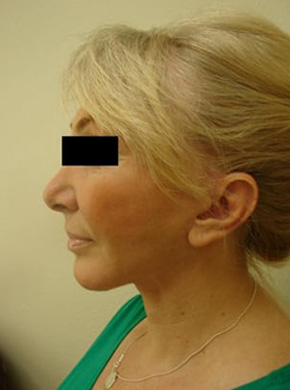 Facelift in San Francisco Patient After 4